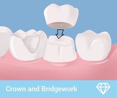 gold coast dental crowns and bridges