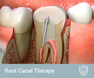 root canal therapy coomera