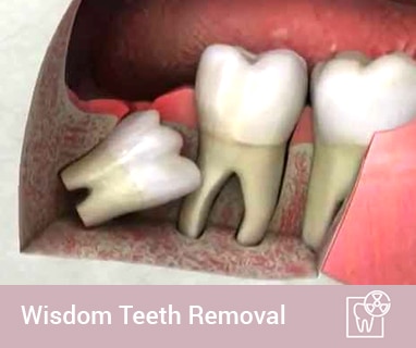 wisdom tooth extraction coomera