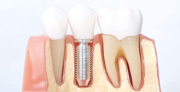 dental implants